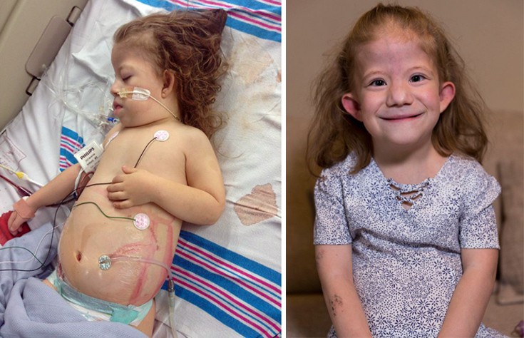 Το κοριτσάκι με την ασθένεια που έχουν μόνο 20 άνθρωποι στον κόσμο