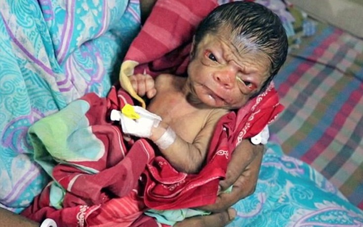 Ο νεογέννητος «Μπέντζαμιν Μπάτον» του Μπαγκλαντές