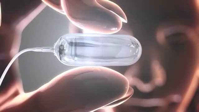 Αδυνατίζουμε καταπίνοντας ένα μπαλόνι