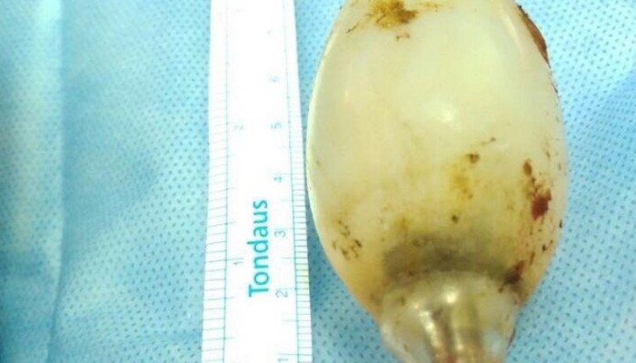 Γιατροί αφαιρέσαν λάμπα που ήταν 11 χρόνια στο στομάχι ενός ανθρώπου