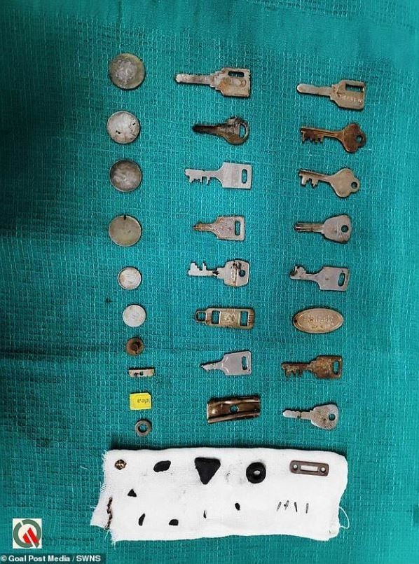 Γιατροί αφαίρεσαν από ασθενή 38 μεταλλικά αντικείμενα: Κλειδιά, κέρματα, μέχρι & κάρτα SΙΜ