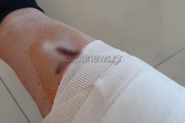 Χανιά: Οι επιθέσεις σκύλων συνεχίζονται - Τρεις δαγκωνιές την έστειλαν στο νοσοκομείο (φωτο)