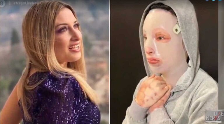 Επίθεση με βιτριόλι - Ιωάννα Παλιοσπύρου: Φωτογραφίες από το πρώτο χειρουργείο - Σκληρές εικόνες