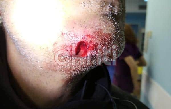 Κρήτη: Δάγκωσε αστυνομικό στο πρόσωπο που τον σταμάτησε για έλεγχο, του έκοψε κομμάτι (φωτο)