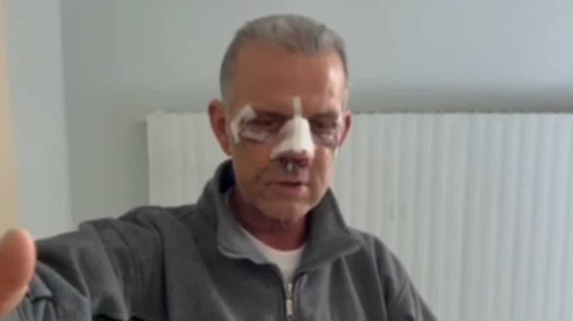 Του ζήτησε να μετακινήσει το αυτοκίνητό του κι εκείνος τον σακάτεψε - Tου έσπασε μύτη, ζυγωματικά και σαγόνι (video)