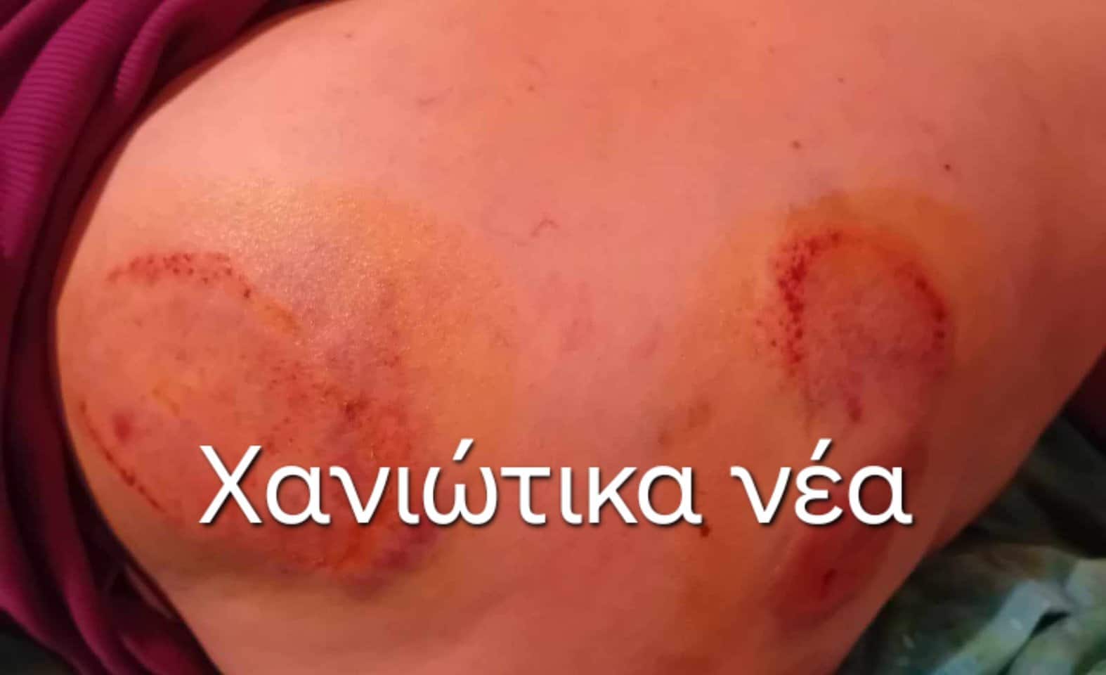 Χανιά: Θαλάσσια χελώνα δάγκωσε λουόμενη στο Μαράθι – Μεταφέρθηκε σε κλινική (φωτο)