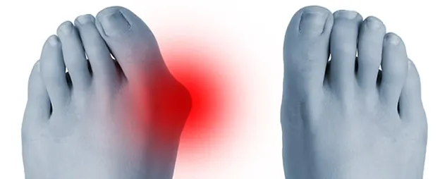 Τι πρέπει να κάνετε εάν έχετε κότσι στο πόδι;