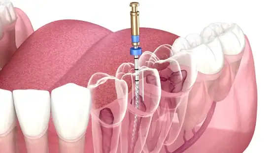 Απονεύρωση Δοντιού: Πότε Είναι Απαραίτητη και Πώς η Ενδοδοντική Θεραπεία Σώζει το Δόντι