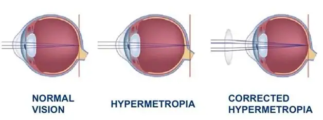 Χειρουργός οφθαλμίατρος για άριστο αποτέλεσμα!
