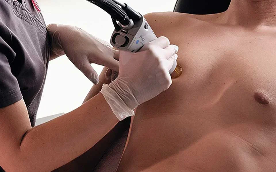 Laser για άνδρες: Όλα Όσα Φοβάστε να Ρωτήσετε