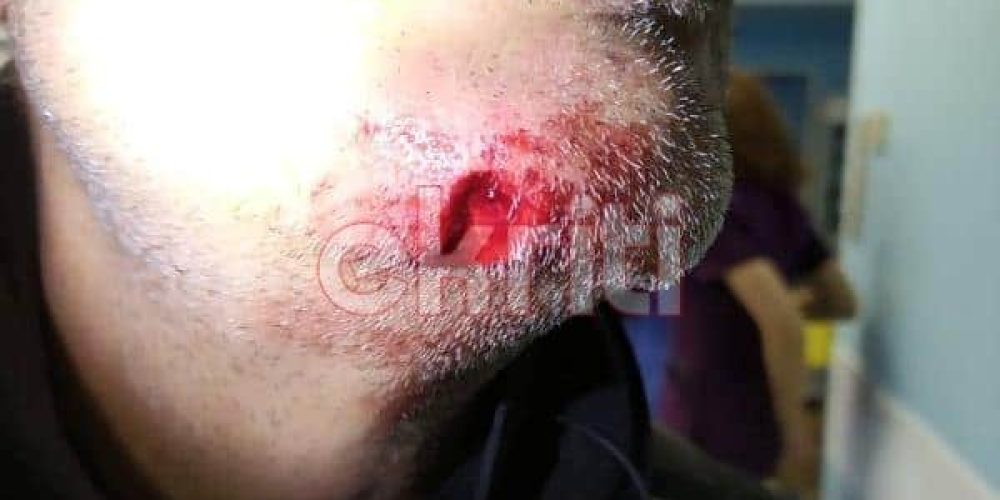 Κρήτη: Δάγκωσε αστυνομικό στο πρόσωπο που τον σταμάτησε για έλεγχο, του έκοψε κομμάτι (φωτο)