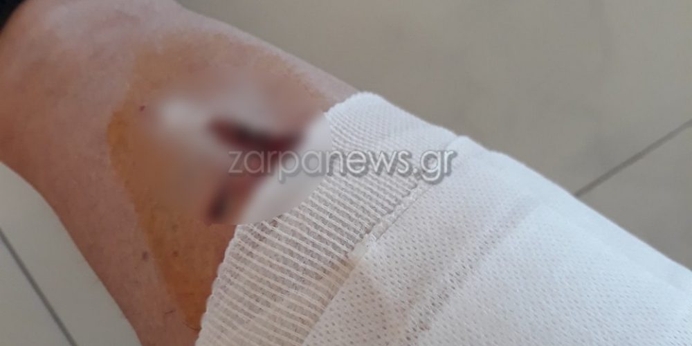 Χανιά: Οι επιθέσεις σκύλων συνεχίζονται – Τρεις δαγκωνιές την έστειλαν στο νοσοκομείο (φωτο)