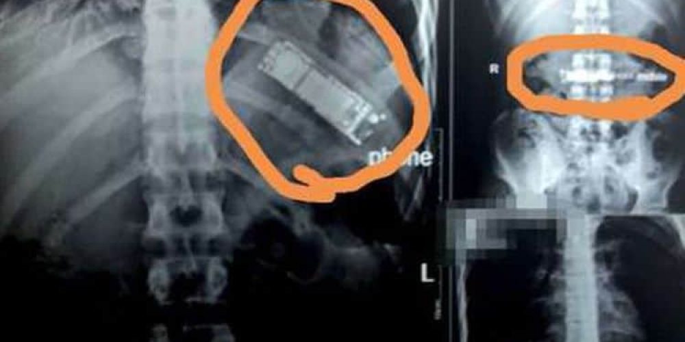 Απίστευτο: Ζούσε έξι μήνες με κινητό τηλέφωνο στο στομάχι του (φωτο)