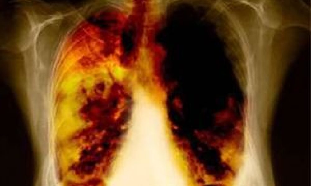 Αφαίρεση όγκων από τους πνεύμονες με λέιζερ