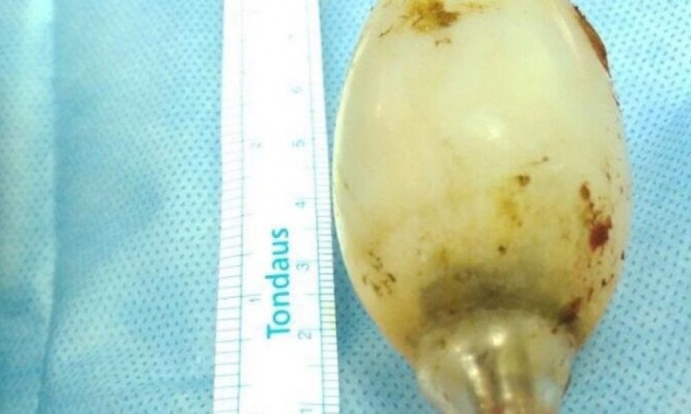 Γιατροί αφαιρέσαν λάμπα που ήταν 11 χρόνια στο στομάχι ενός ανθρώπου