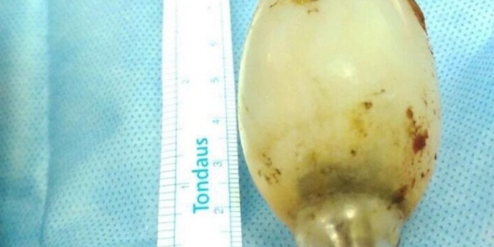 Γιατροί αφαιρέσαν λάμπα που ήταν 11 χρόνια στο στομάχι ενός ανθρώπου