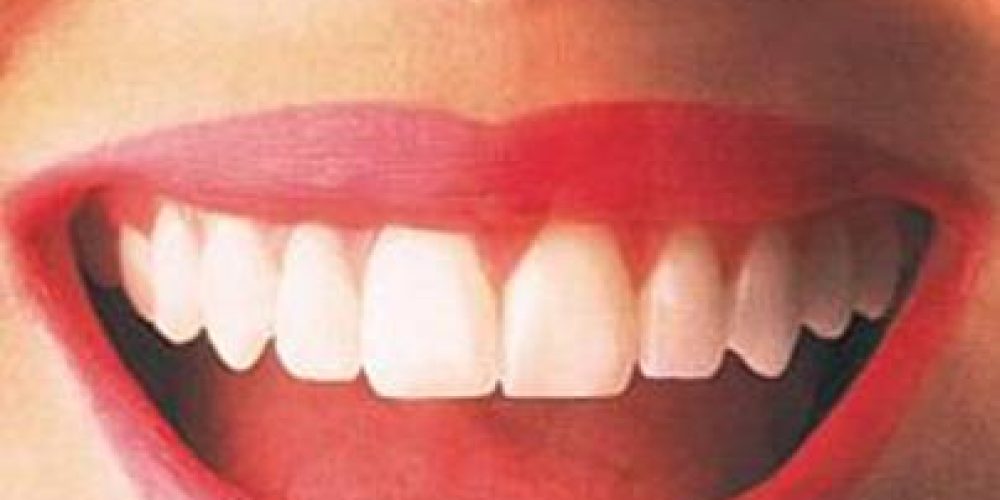 Λεύκανση δοντιών για υπέροχο χαμόγελο