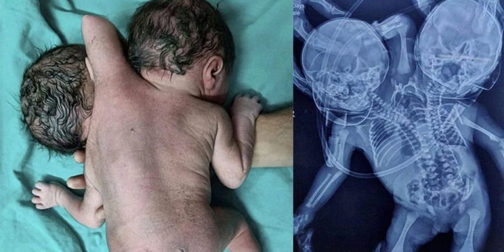 Μωρό γεννήθηκε με δύο κεφάλια, τρία χέρια και δύο καρδιές (video)