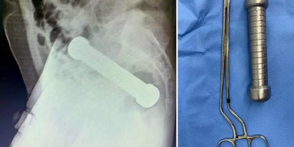 Άνδρας έβαλε βαράκι 2 κιλών στον πρωκτό του – Έμεινε εκεί για 2 μέρες μέχρι να χειρουργηθεί