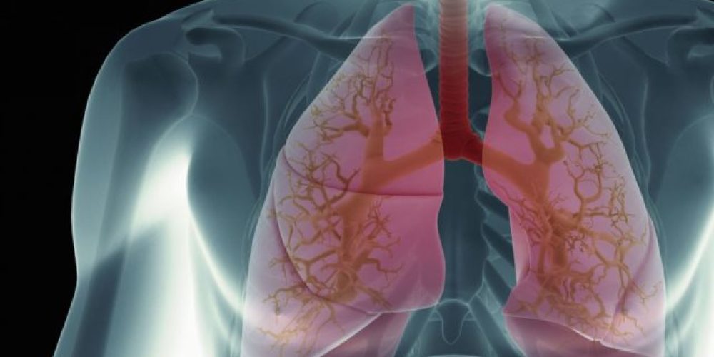 Μεταμόσχευσαν σε γυναίκα πνεύμονες καπνίστριας και πέθανε από καρκίνο