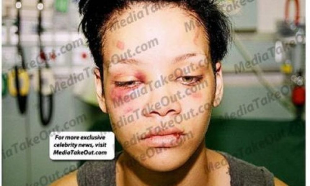 Σοκ: νέες φωτογραφίες από τον ξυλοδαρμό της Rihanna