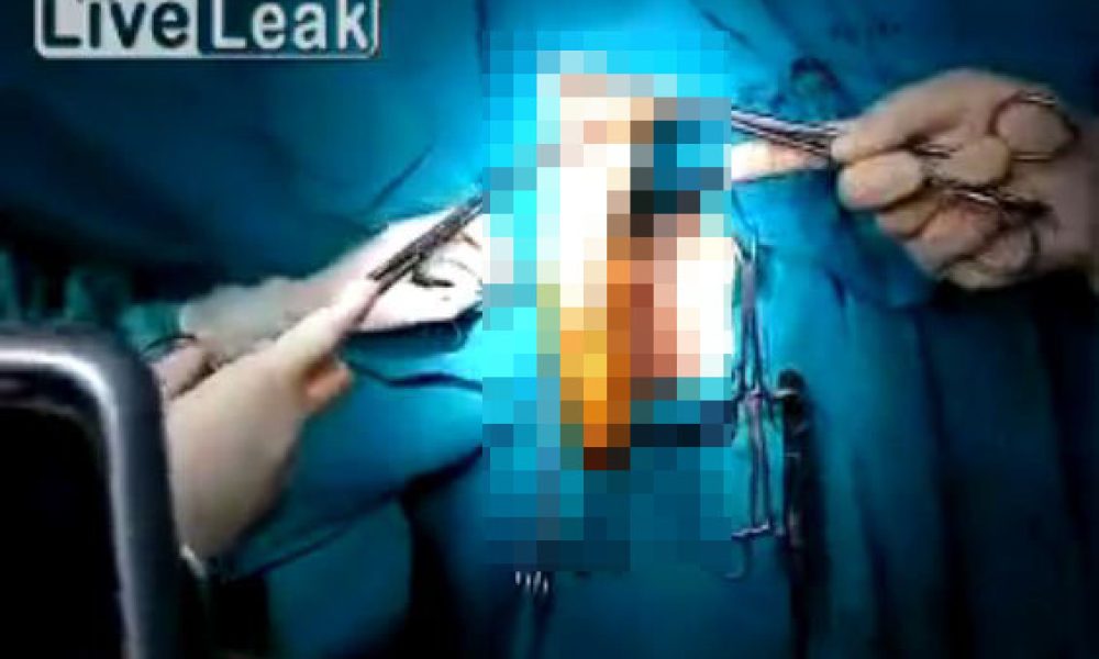 Έλληνας κατέληξε στο νοσοκομείο με δονητή στο πρωκτό (Ακατάλληλο video)