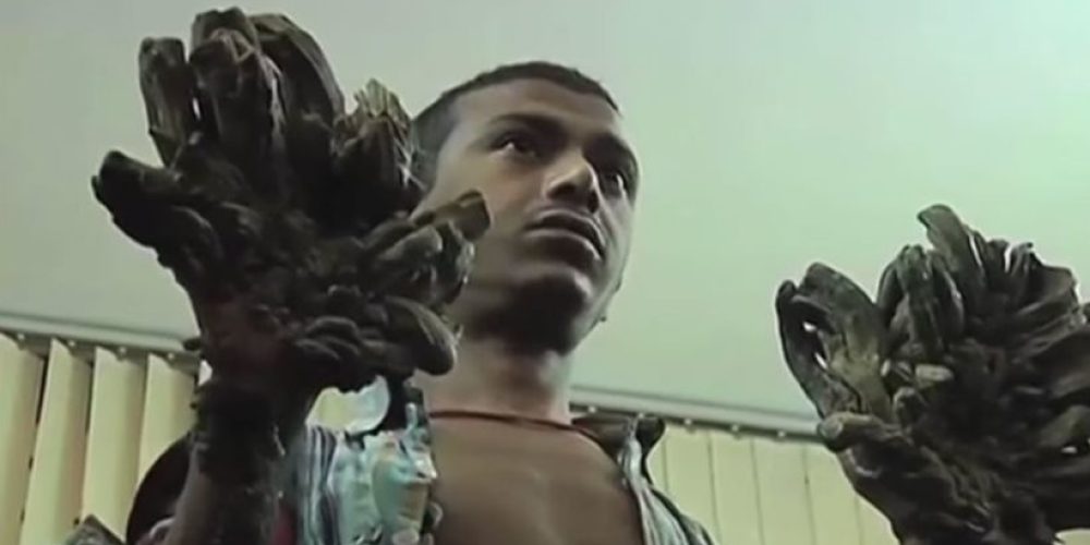 Μπαγκλαντές: Ο «άνθρωπος-δέντρο» γιατρεύτηκε μετά από 16 επεμβάσεις