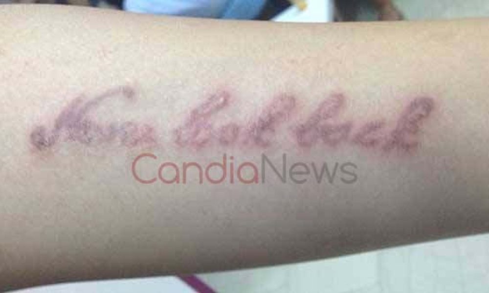 Κρήτη: Δείτε τι έπαθε 12χρονη από τατουάζ χένας